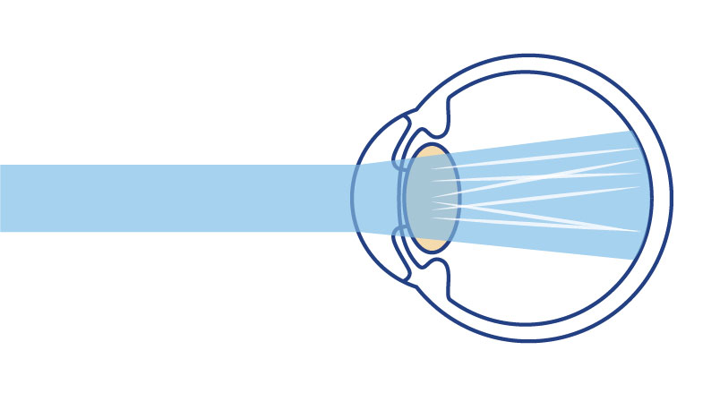Image of a Cataract Eye Lens