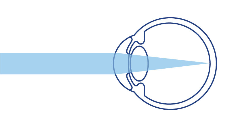 Image of a Normal Eye Lense
