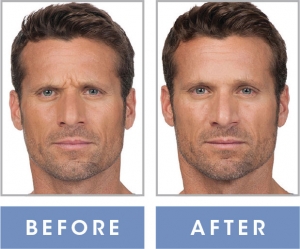 Botox: Before and After